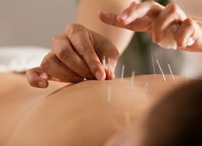 The doctor sticks needles into the girl's body on the acupuncture - close up